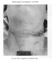 comparison strangulation autopsy photo.jpg