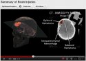 impact brain injuries graphic youtube 4A.jpg