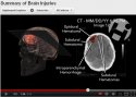 impact brain injuries graphic youtube 4.jpg