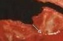 autopsy Cracked skull crop comminuted area enlarged w arrow D.jpg